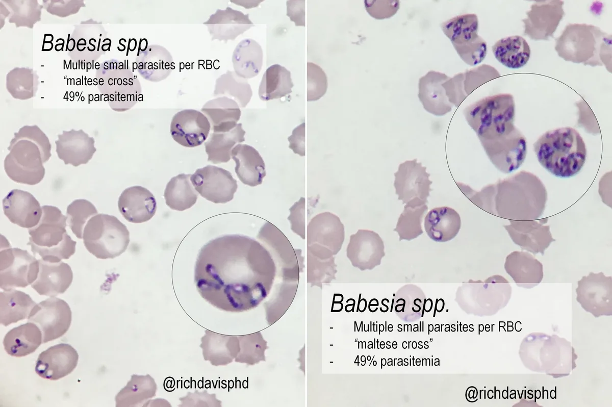 Babesiosis blood smear