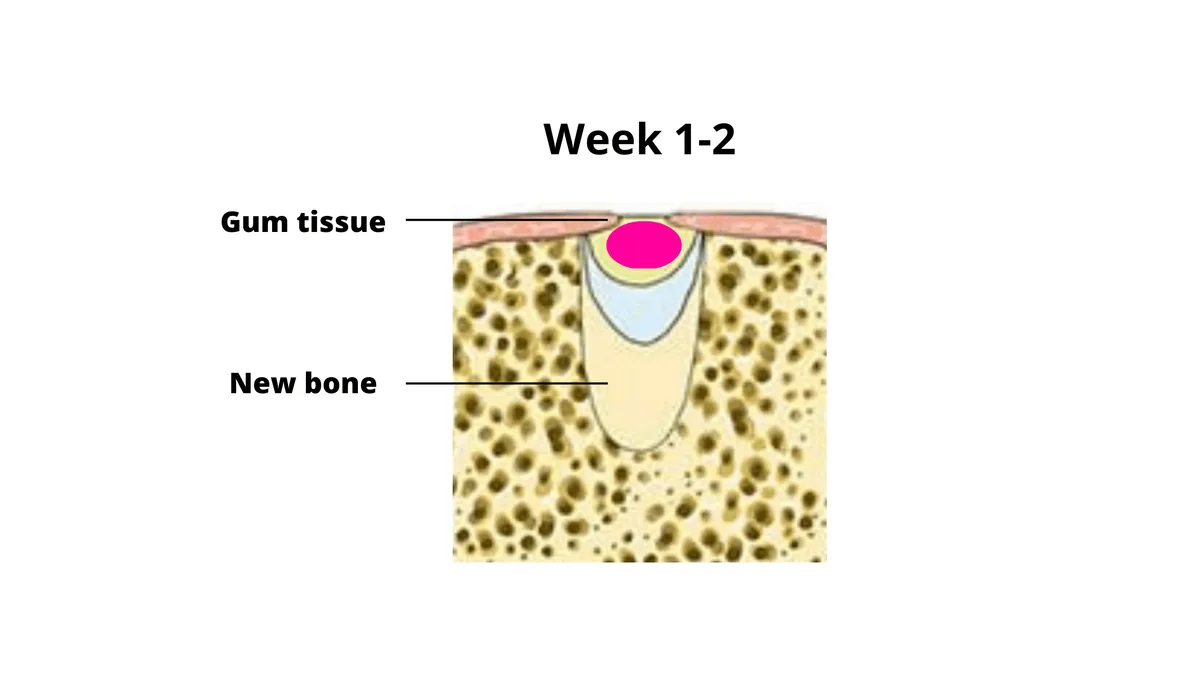 bone spicule
