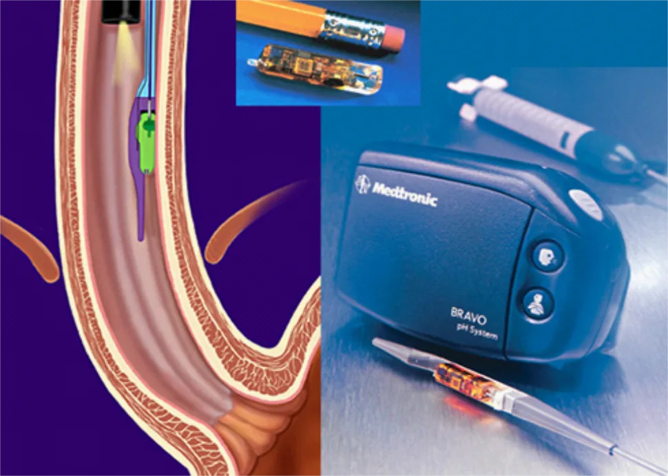 Bravo Reflux Recorder Troubleshooting