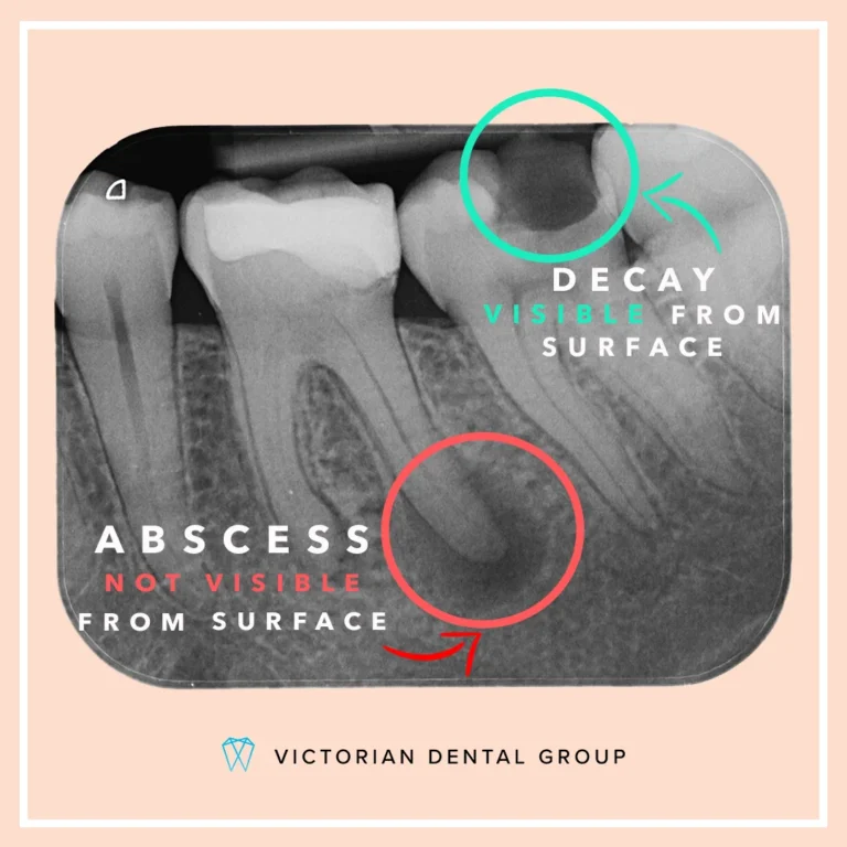 Can I Fly With An Abscessed Tooth