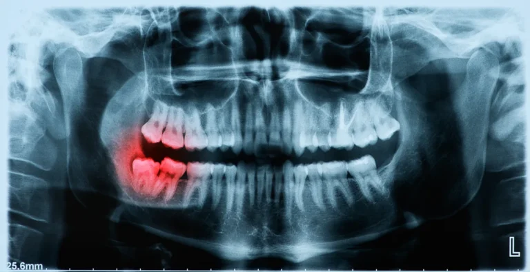 Does Intellicare Cover Wisdom Tooth Extraction