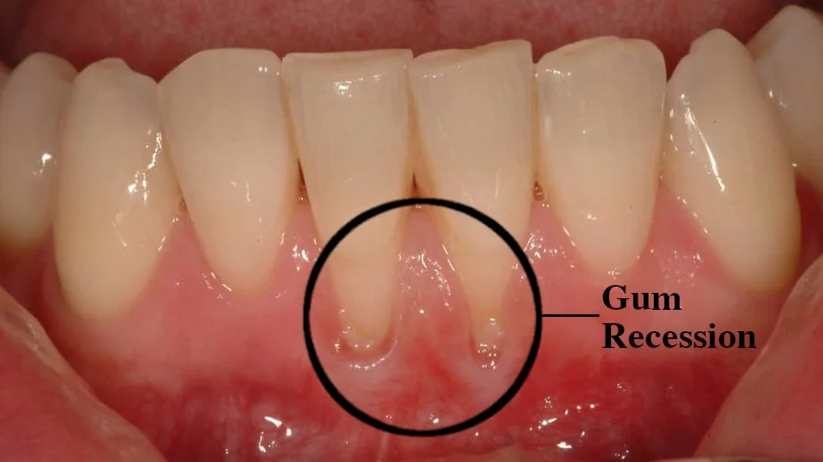How To Fix Receding Gums