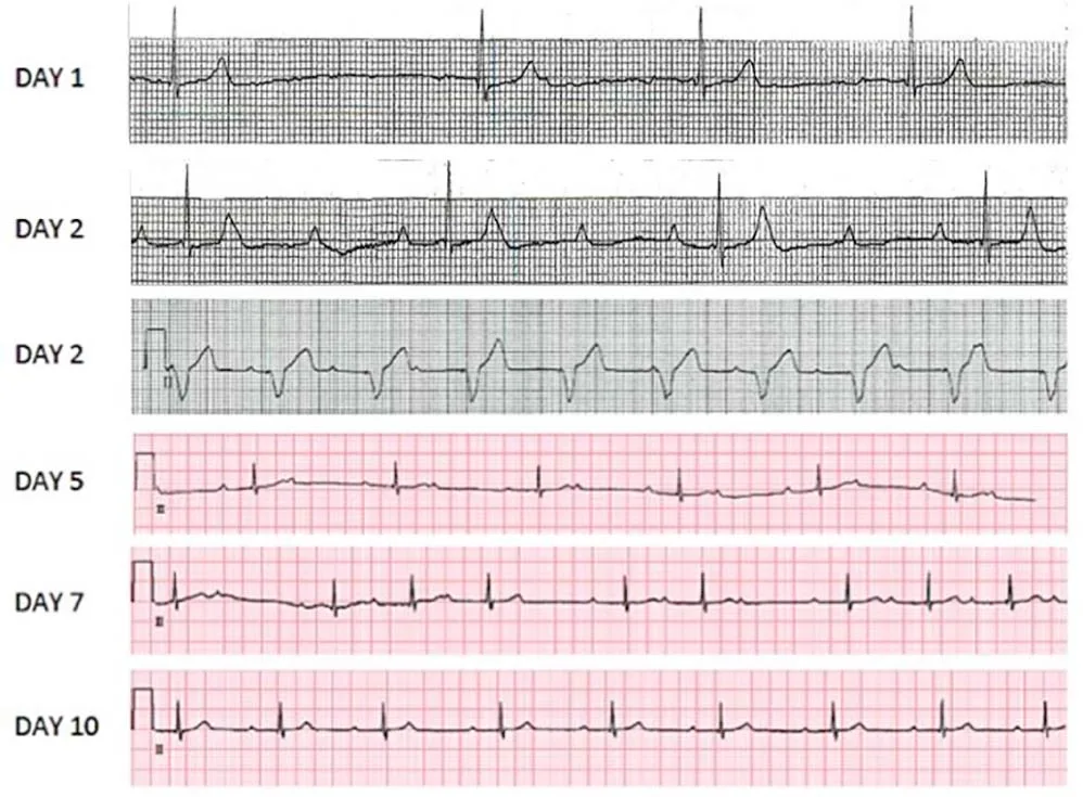 Lyme carditis ECG