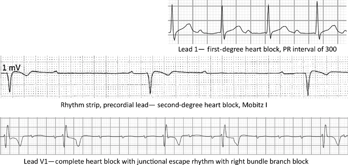 Lyme disease breathing problems