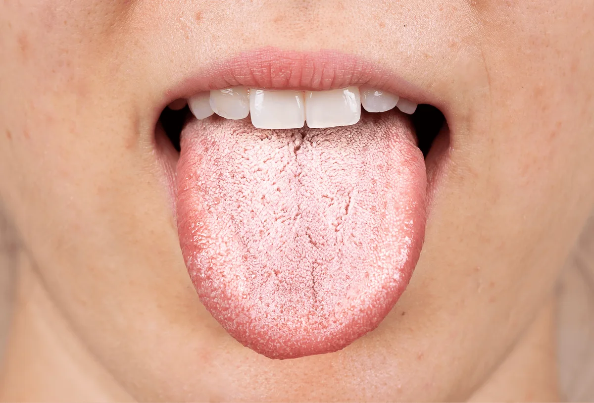 Oral thrush