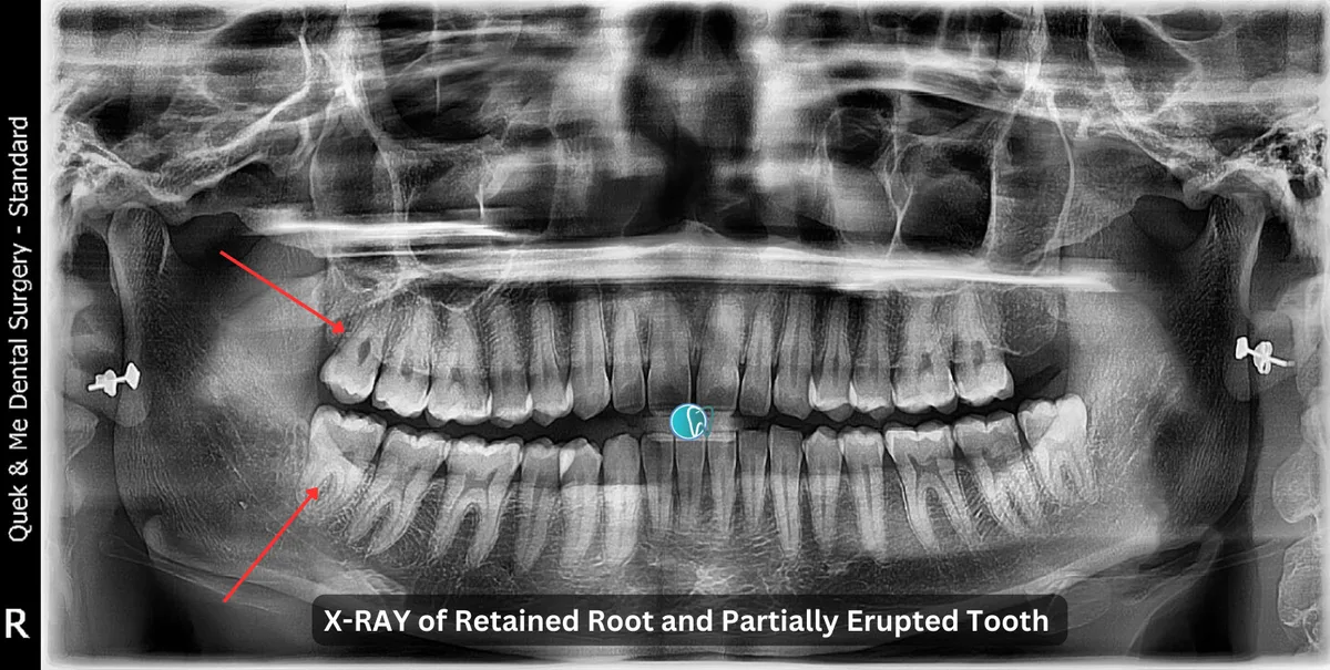 Pain Where Wisdom Tooth Was Removed Months Later