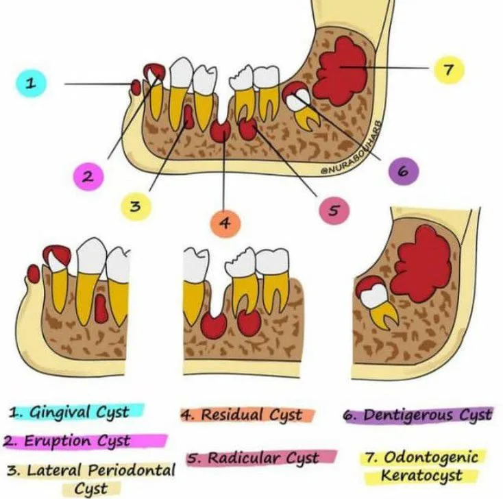 Residual cyst