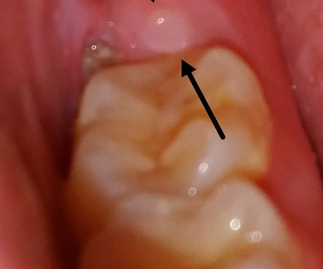 White Spot On Gum Where Wisdom Tooth Was