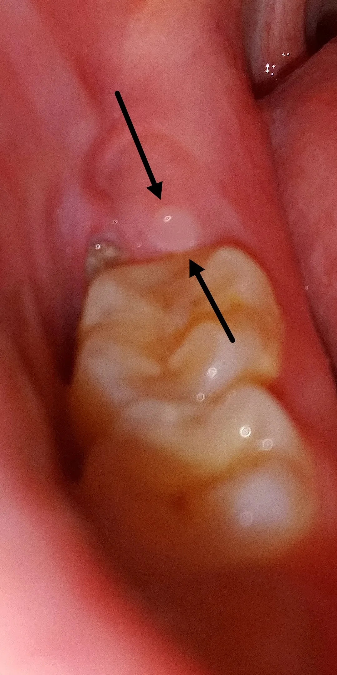 White Spot On Gum Where Wisdom Tooth Was